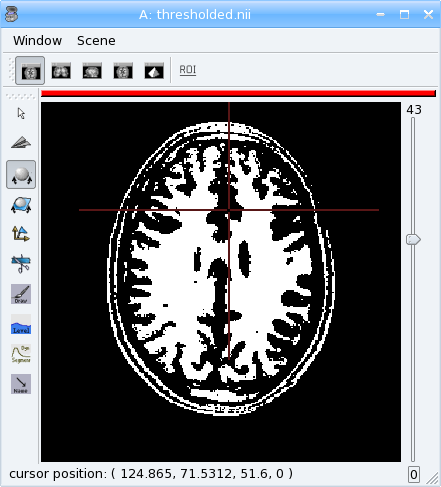 Thresholded T1 MRI